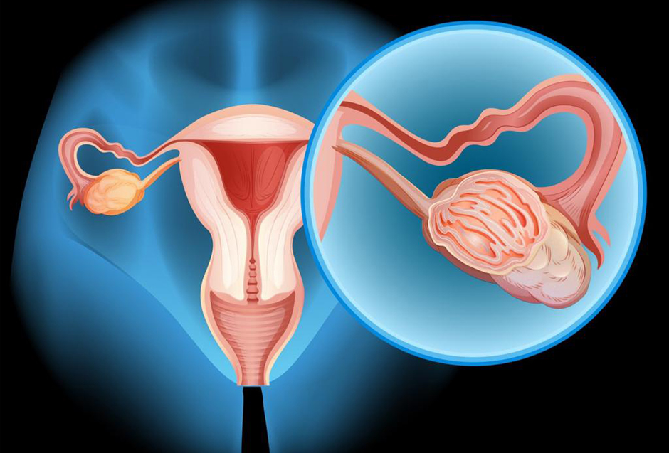 Норма онкомаркера ca 125 у женщин при кисте яичника